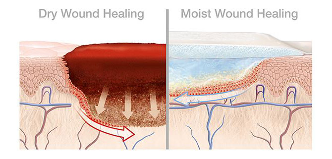 Moist healing conditions