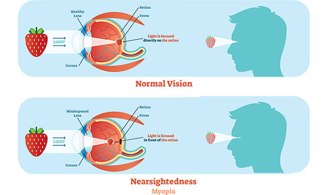 Myopia Diagram